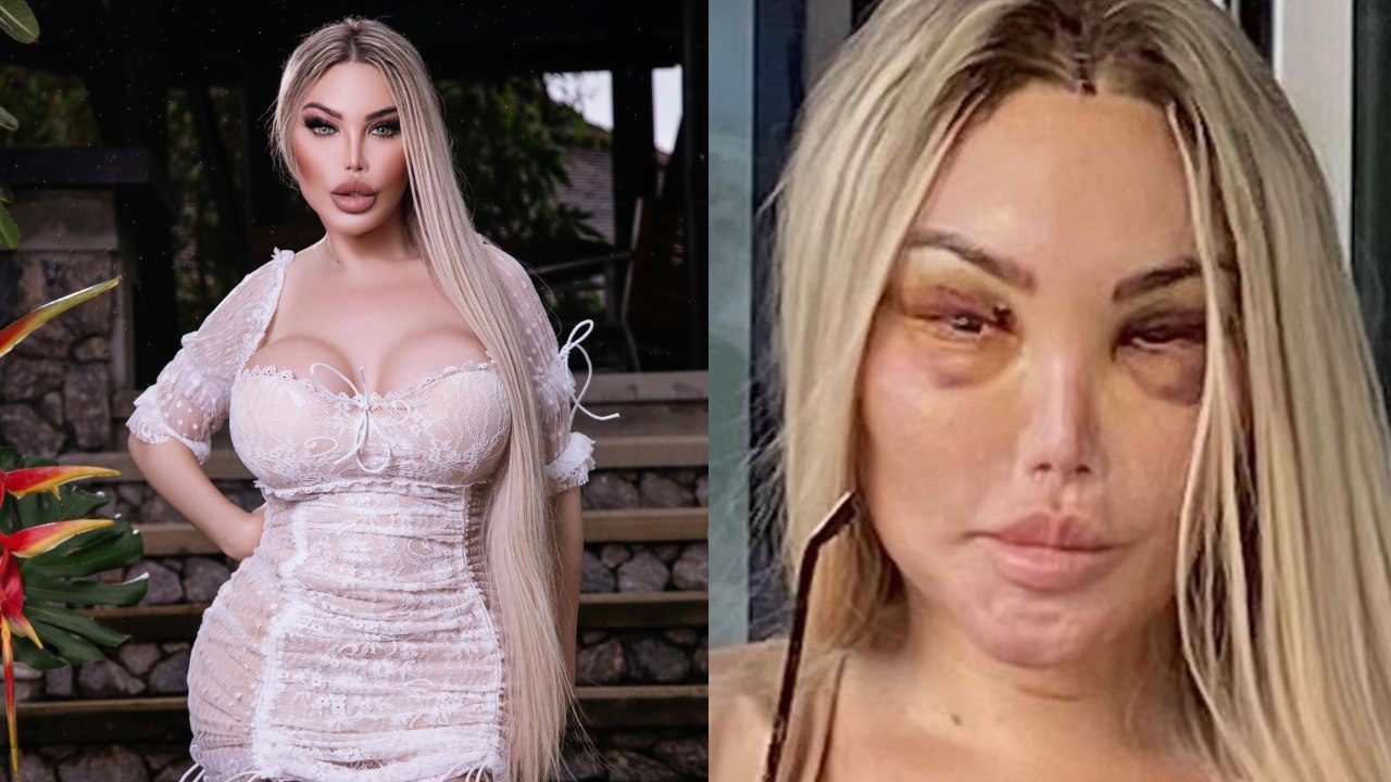 Barbie Humana moretones cara tratamientos esteticos