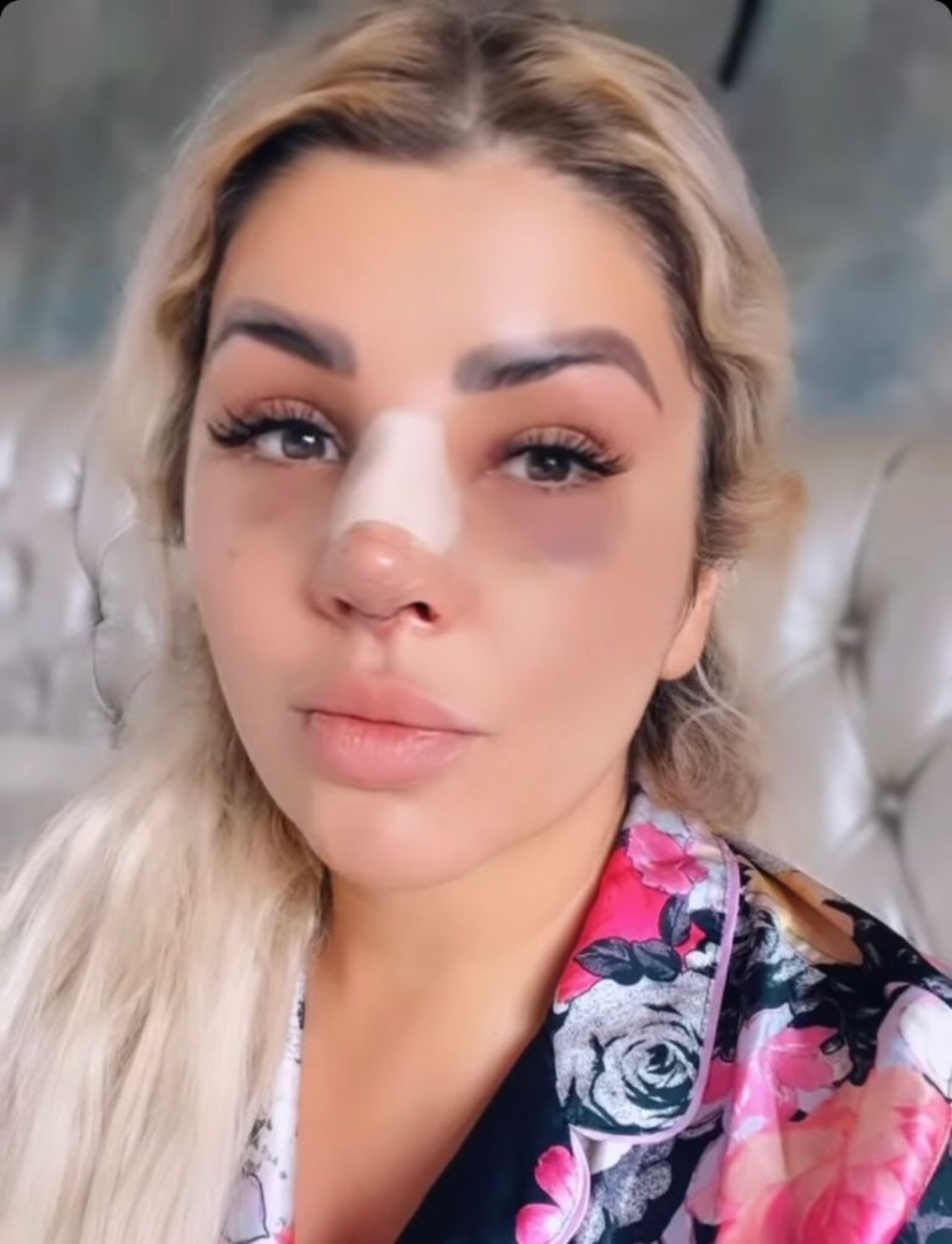 mariana gonzalez moretones cara nariz operada