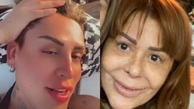 Kunno rostro arreglo botox operacion