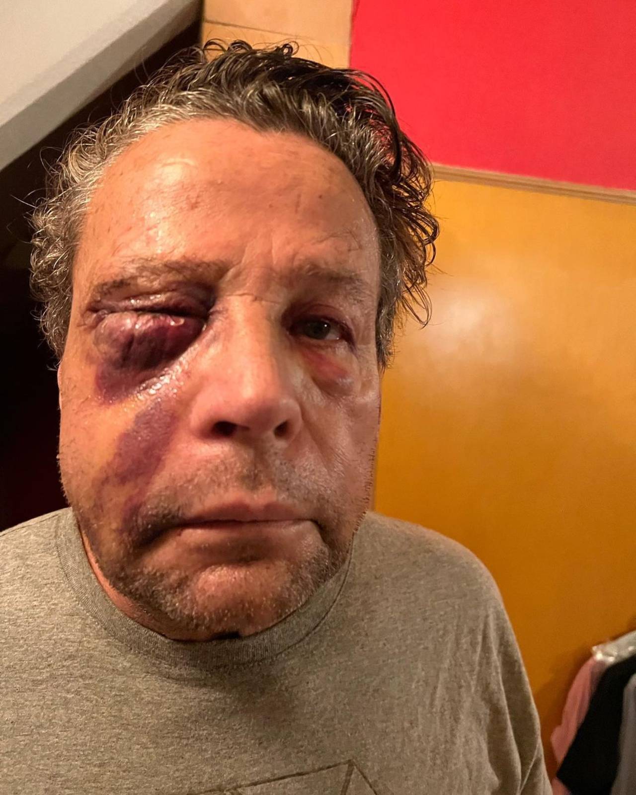 Alfredo Adame todo hinchado por golpes