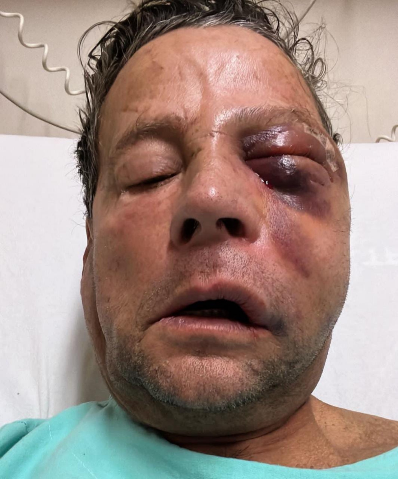 Alfredo Adame ojo hinchado