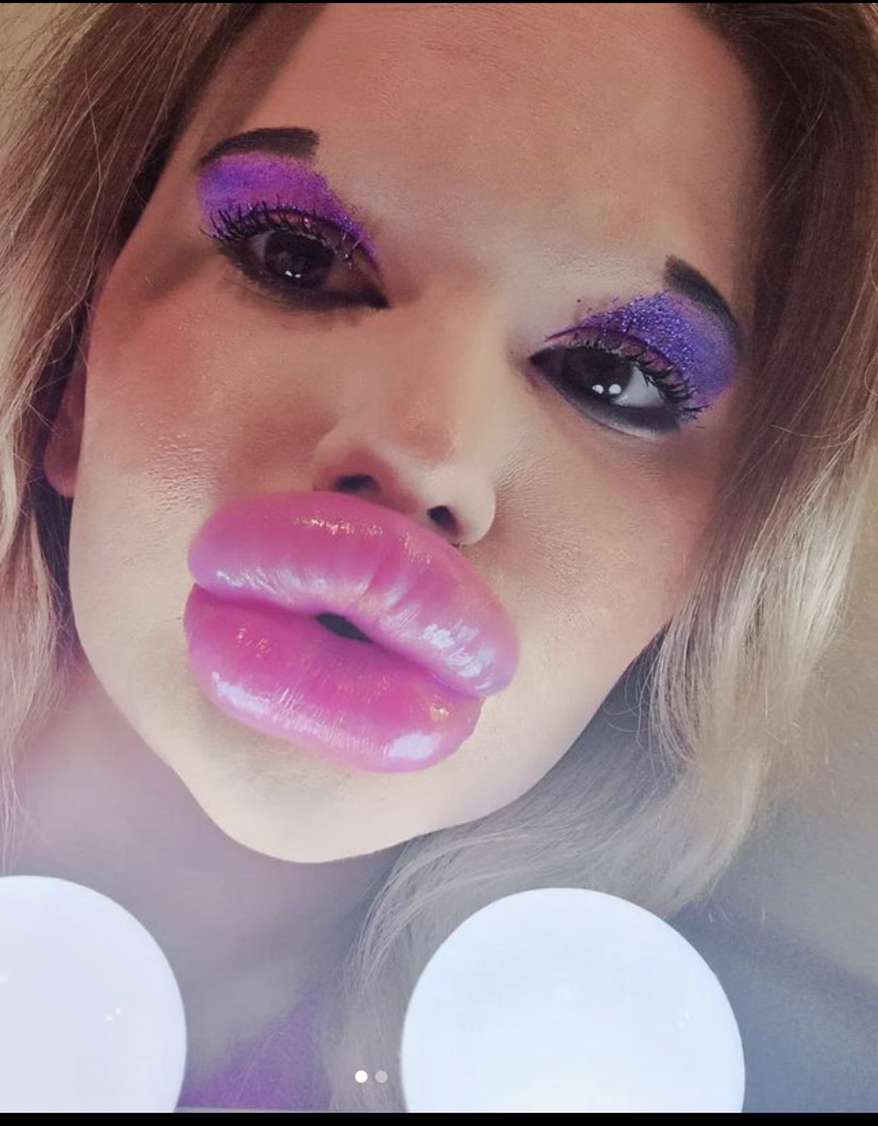 influencer cirugía estética labios fotos