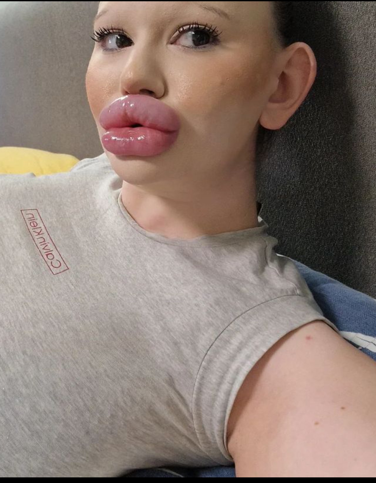 influencer cirugía estética labios