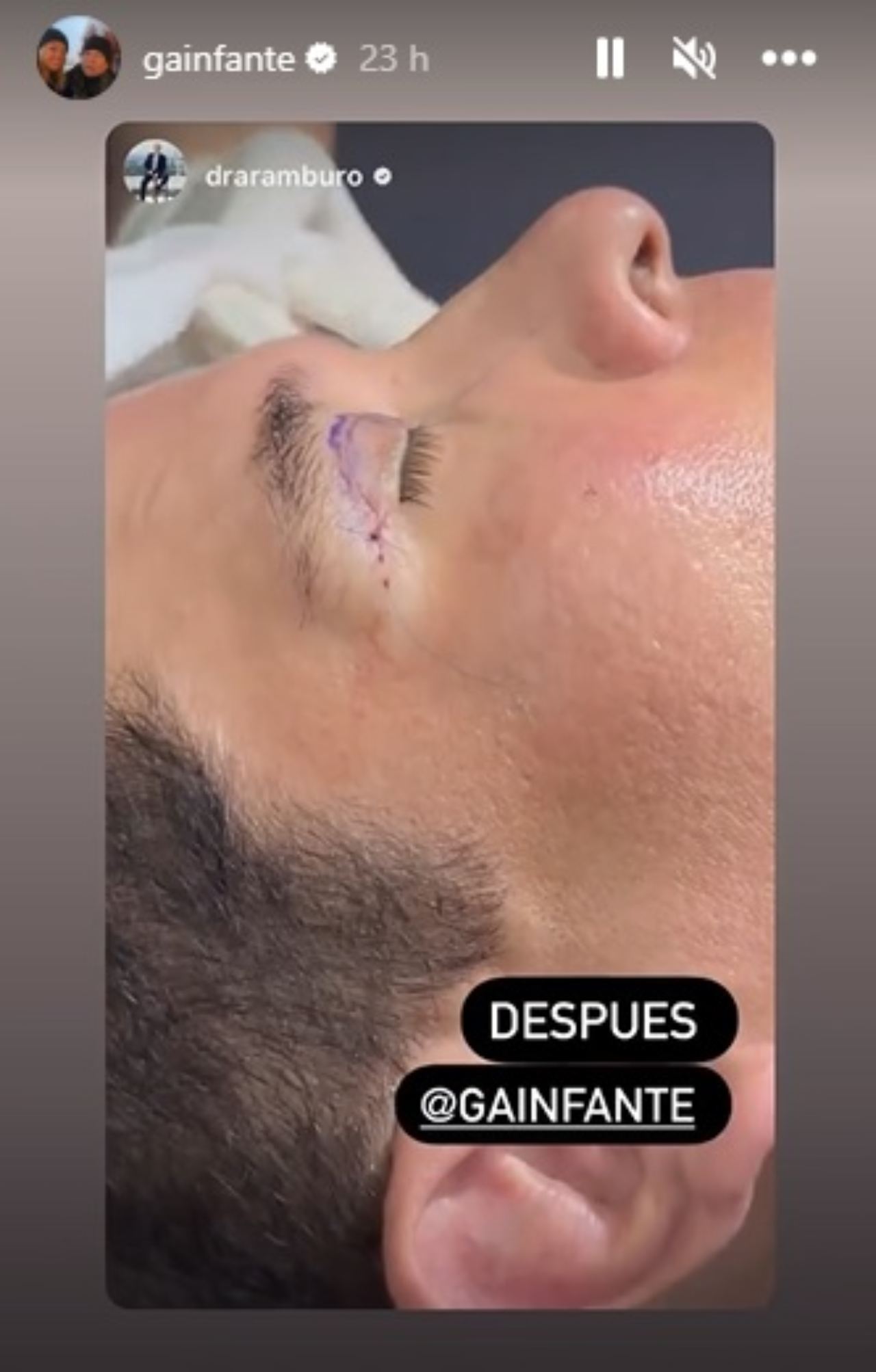 Gustavo Adolfo Infante cirugia parpados rejuvenecer