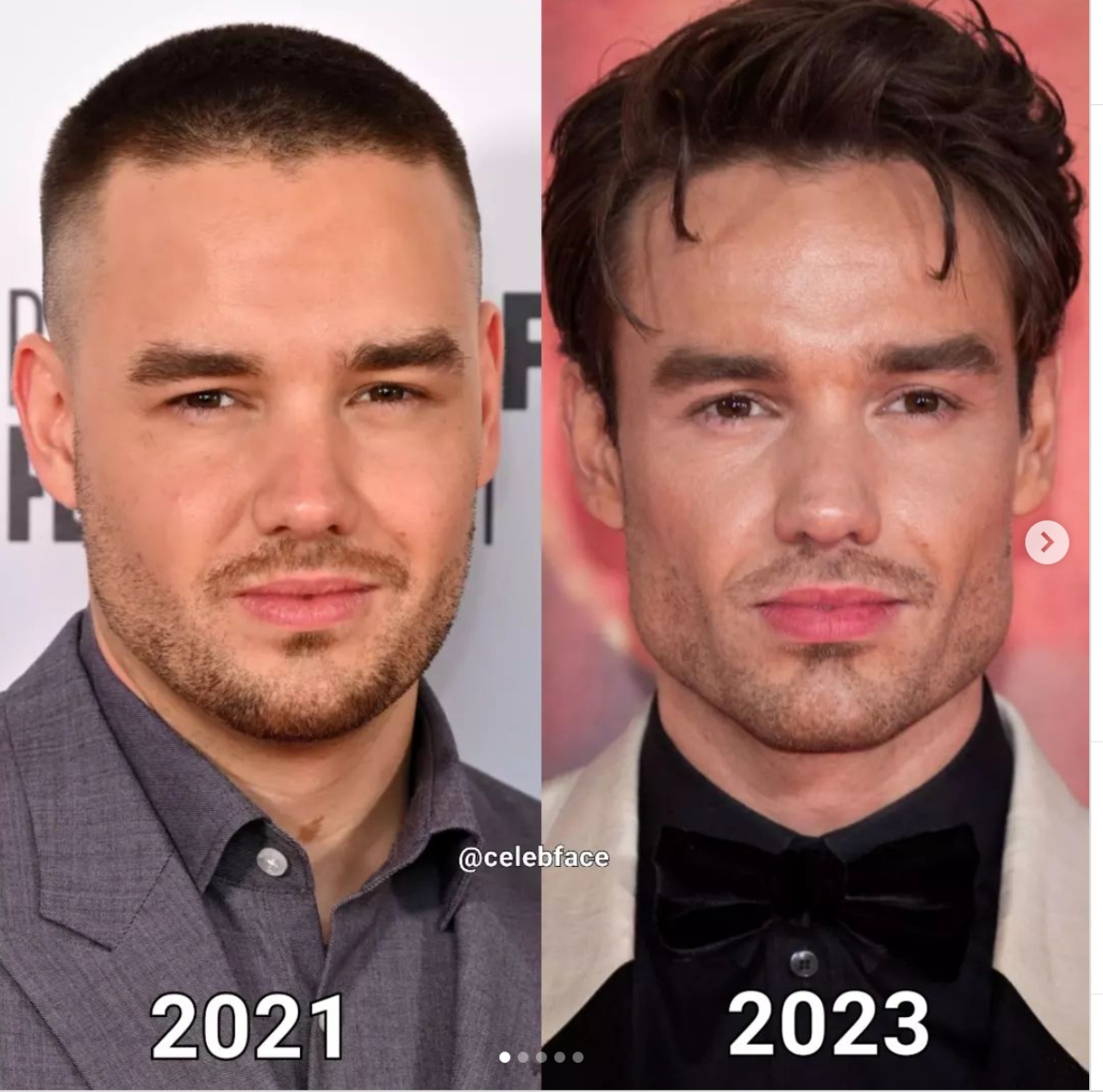 Lyam Payne One Direction bichectomia