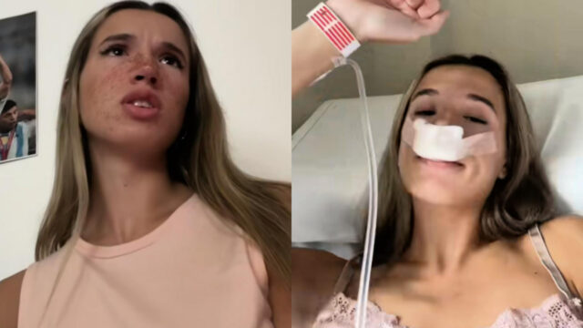 Chica rinoplastia